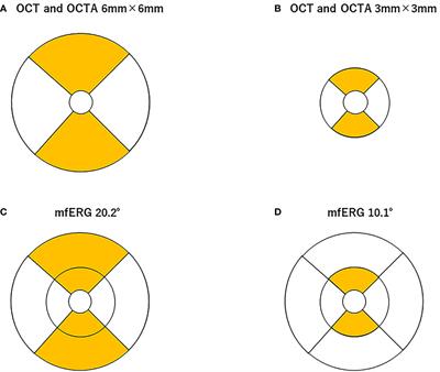 Evaluations of microvascular density by optical coherence tomography, angiography, and function by multifocal electroretinography of the macular area in eyes with branch retinal artery occlusion